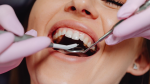 Diş eti şişmesi neden olur? Belirtileri ve tedavi yöntemleri